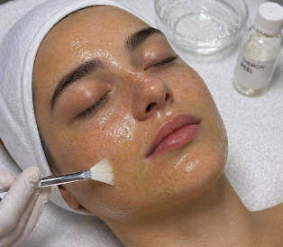 Medium chemical peel treatment
